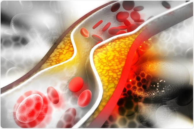 Cholesterol plaque in artery, illustration. Image Credit: hywards / Shutterstock